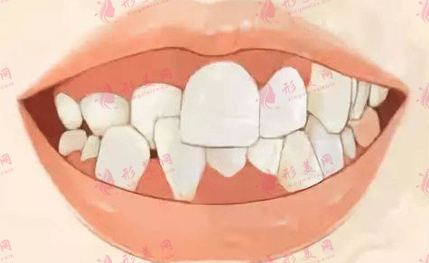 牙齒矯正 牙齒矯正