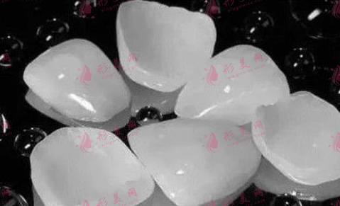 樹脂牙貼面