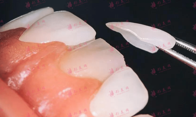 牙貼面 牙貼面