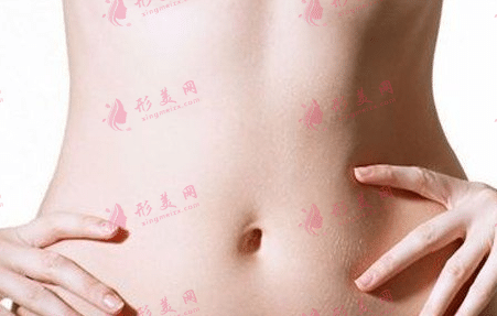 腰腹吸脂 腰腹吸脂
