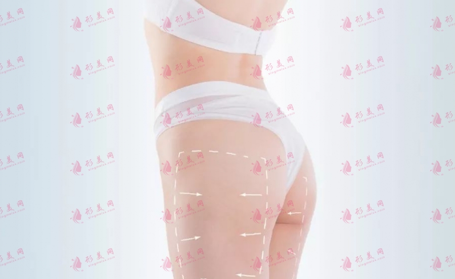 大腿吸脂 大腿吸脂