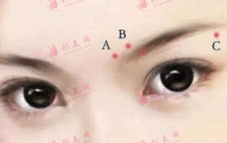 提眉術(shù)的適應(yīng)范圍|提眉術(shù)后可以敷冰袋嗎？