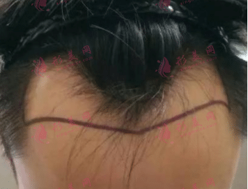 合肥雍禾植發(fā)醫(yī)院植發(fā)際線種植多少錢 還會再掉嗎