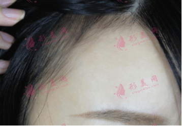 發(fā)際線種植后長(zhǎng)出來的頭發(fā)還會(huì)再掉嗎? 發(fā)際線種植后長(zhǎng)出來的頭發(fā)還會(huì)再掉嗎?