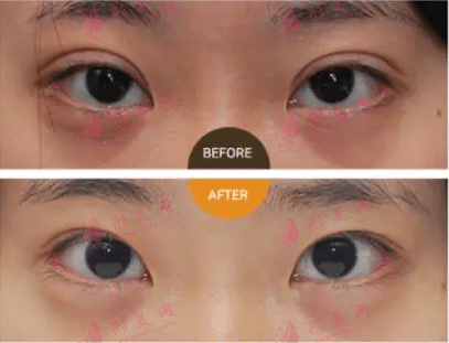 雙眼皮失敗修復(fù)方法有哪些? 雙眼皮失敗修復(fù)方法有哪些?