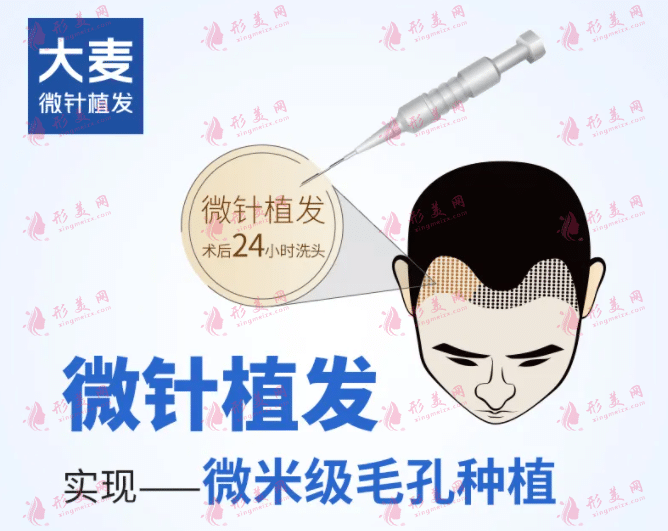 大麥微針植發(fā)是正規(guī)醫(yī)院?jiǎn)?？植發(fā)費(fèi)用貴嗎？附收費(fèi)價(jià)格表