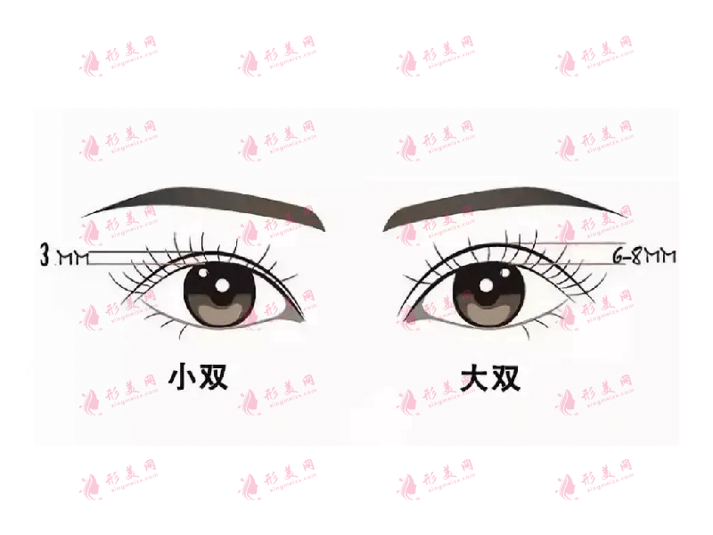 全切雙眼皮