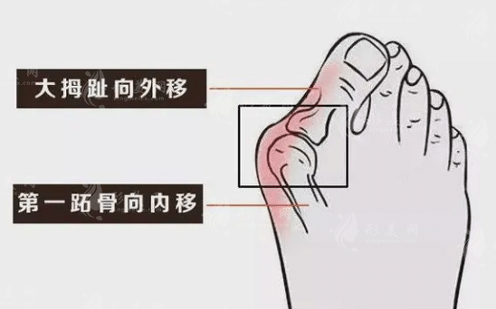 北京做大腳骨選擇哪位醫(yī)生好?蘇敬達、馬桂文、陳圣英等專家