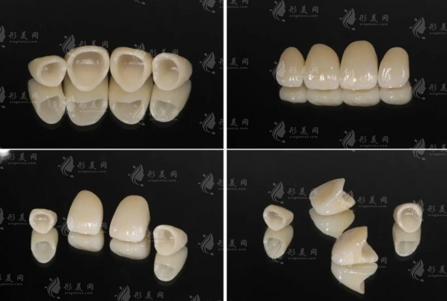 烤瓷牙一顆大約多少錢(qián)？?jī)r(jià)格表2023揭曉！幾百到幾千都有！