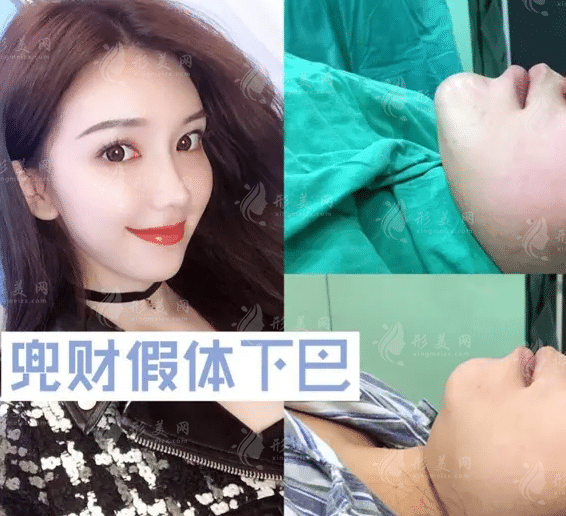 假體墊下巴手術(shù)費(fèi)用需要多少錢