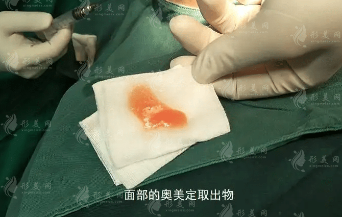 奧美定取出需要多少錢？面部/鼻部/胸部奧美定取出方法不同費用有區(qū)別