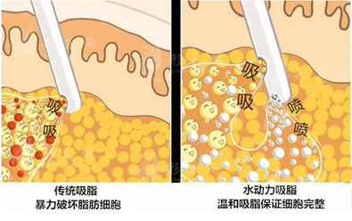 水動力吸脂手術(shù)效果怎么樣？收費(fèi)價格貴嗎？