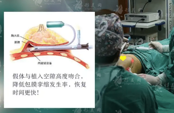 內(nèi)窺鏡假體豐胸多少錢？項目有危害嗎？