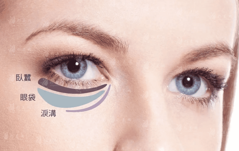 不開刀去眼袋能保持多久？手術有風險嗎？