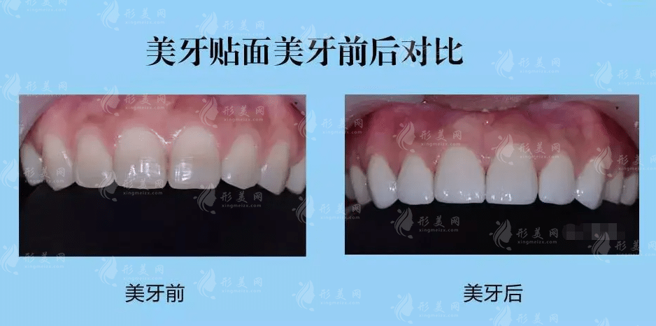 做牙齒貼面的時(shí)間長不長? 做牙齒貼面的時(shí)間長不長?