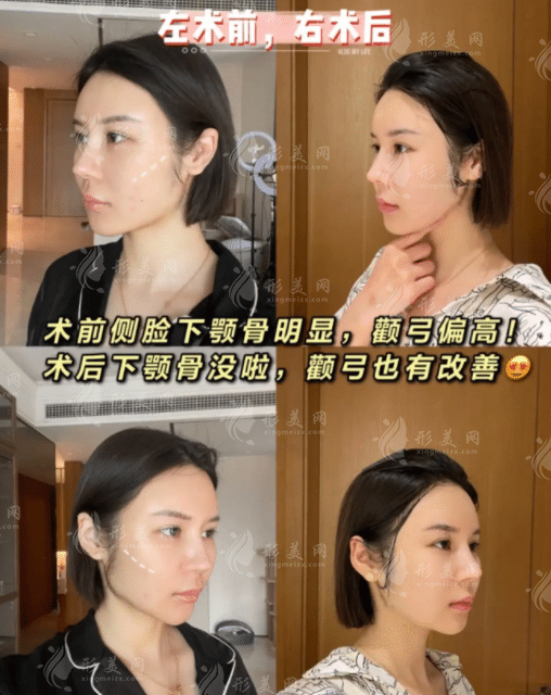 武漢亞韓趙貴慶磨骨怎樣？下頜角術(shù)后效果變化大嗎？