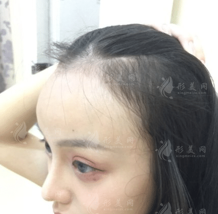 長(zhǎng)春韓尚植發(fā)醫(yī)院怎么樣？2022發(fā)際線種植案例展示