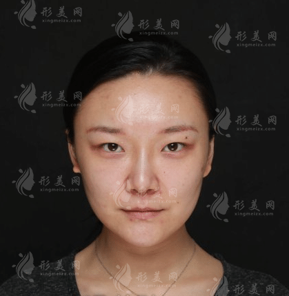 四川華西醫(yī)院光子嫩膚效果怎么樣？醫(yī)院實(shí)力及案例分享
