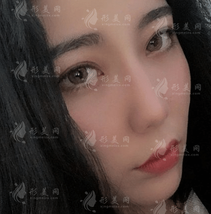 上海九院祝聯(lián)隆鼻多少錢？全新收費(fèi)標(biāo)準(zhǔn)及案例一覽