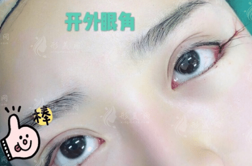 開外眼角會不會有疤痕?