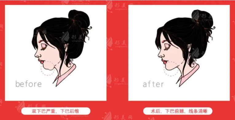 廣州做下巴后縮手術(shù)大概多少錢? 廣州做下巴后縮手術(shù)大概多少錢?