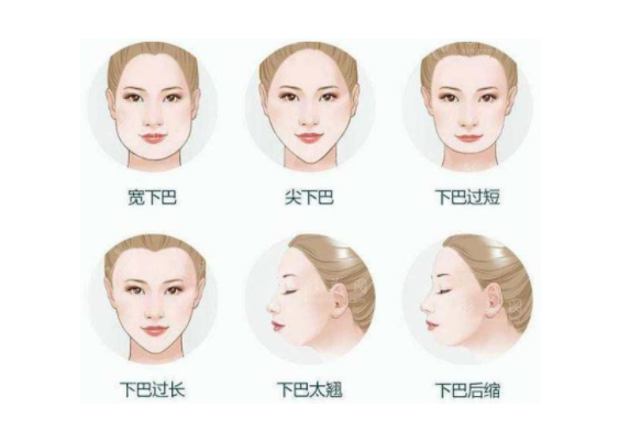 下巴后縮手術(shù) 下巴后縮手術(shù)