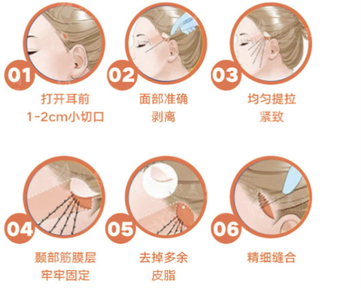 小切口提升 小切口提升