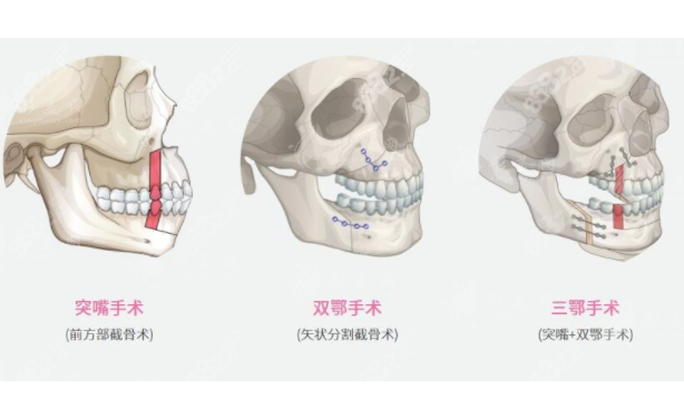 什么情況下適合正頜手術(shù)？