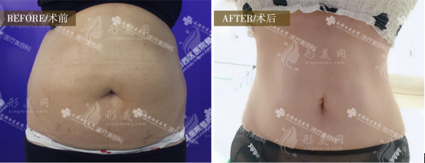 成都西區(qū)宋華敬腰腹吸脂怎么樣？顧客真實評價！
