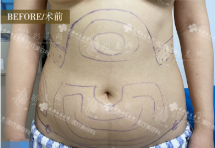 成都西區(qū)宋華敬腰腹吸脂怎么樣？顧客真實評價！