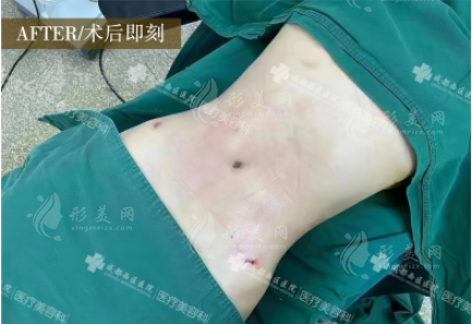 成都西區(qū)宋華敬腰腹吸脂怎么樣？顧客真實評價！