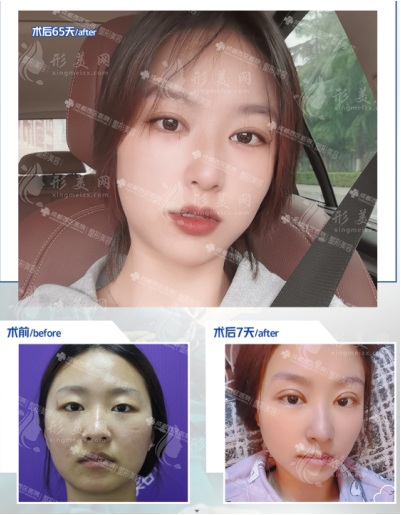 成都西區(qū)楊世界做雙眼皮什么風(fēng)格？有真實案例哦~