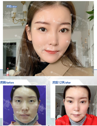 成都西區(qū)楊世界做雙眼皮什么風(fēng)格？有真實案例哦~