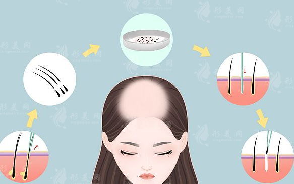 四川省人民醫(yī)院可以植發(fā)嗎？醫(yī)生介紹+案例分享+價(jià)格表