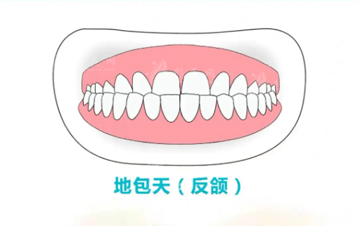 地包天矯正需要多少錢？地包天矯正最佳年齡，效果理想嗎？