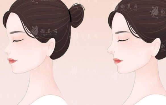 復旦大學附屬華山醫(yī)院隆鼻技術(shù)如何？醫(yī)生介紹+案例分享+價格表