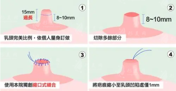 乳頭縮小