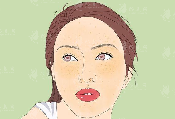 上海治療雀斑哪家好？多少錢？