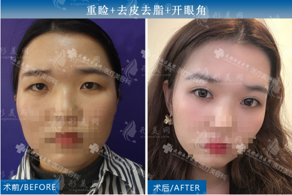 成都西區(qū)楊世界做雙眼皮可靠嗎？簡(jiǎn)介、擅長(zhǎng)及顧客反饋展示