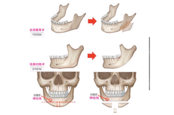下頜角截骨手術(shù)