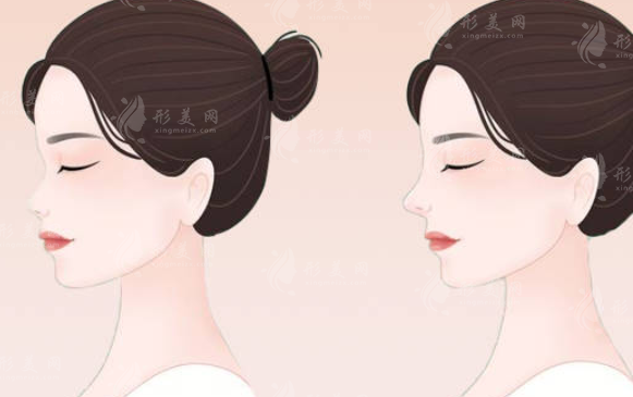 四川華美紫馨美容醫(yī)院的蘇辰楓隆鼻怎么樣？案例分享+價格表