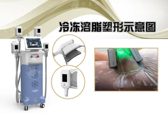 冷凍溶脂