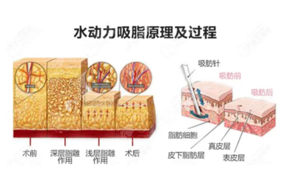 水動力吸脂和緊膚美容手術哪個好？一起來看看吧