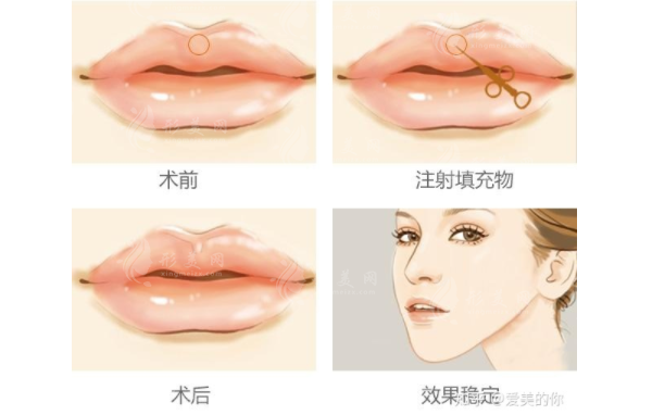 常見的唇部整形手術(shù)方法有哪些？唇部填充術(shù)、唇部提升術(shù)…