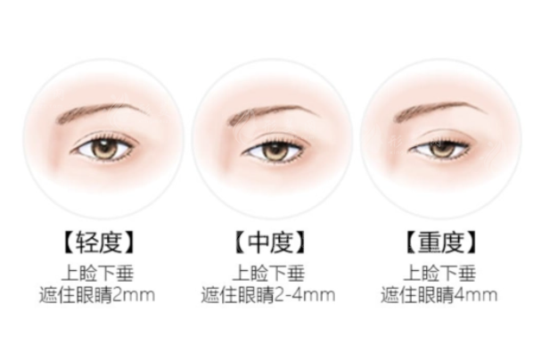 眼瞼下垂矯正方法是什么？上瞼提升術、眼輪匝肌重建術...