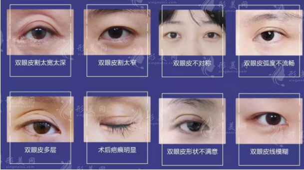 雙眼皮手術(shù)類型有哪些？割雙眼皮術(shù)、點切雙眼皮術(shù)…