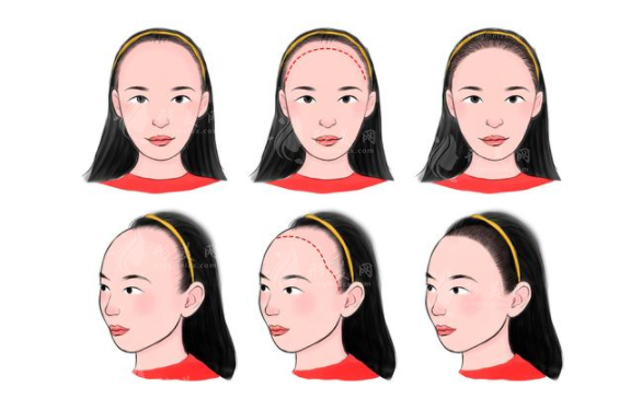 西京醫(yī)院發(fā)際線種植多少錢？案例分享、醫(yī)生介紹、收費(fèi)價(jià)格匯總！