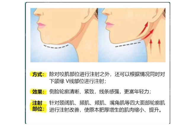 下頜緣提升多久打一次？效果能維持多久？