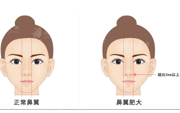 寬鼻矯正和鼻骨內(nèi)推一樣嗎？兩者有什么區(qū)別？