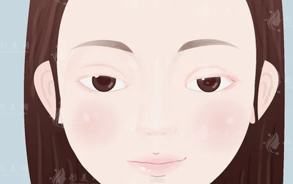 做上眼皮提拉手術(shù)恢復期是多久？有風險嗎？